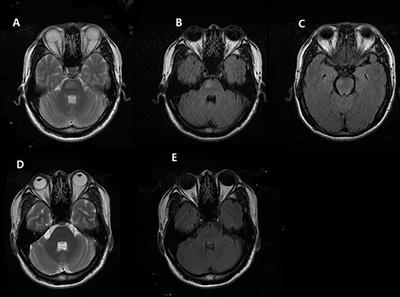 Posterior Reversible Encephalopathy Syndrome With Isolated Involving Infratentorial Structures